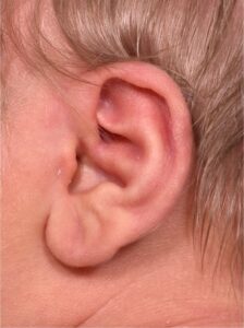 Earwell Atlanta near me baby ear correction congenital otoplasty best expert nonsurgical