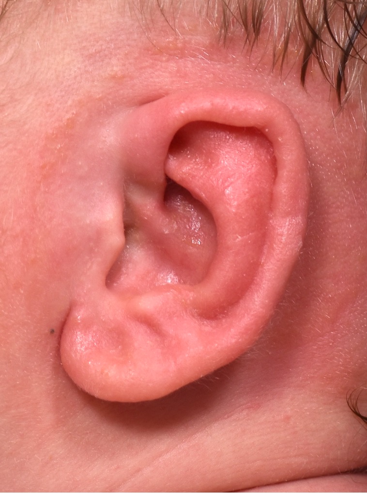 Earwell Atlanta near me baby ear correction congenital otoplasty best expert nonsurgical