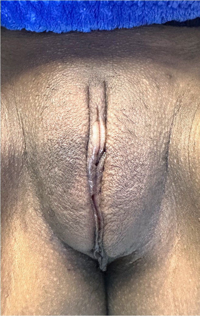 Atlanta labiaplasty near me best expert intimate plastic surgeon results before and after clitoral hood reduction vagina perineoplasty