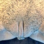 Atlanta labiaplasty near me best expert intimate plastic surgeon results before and after clitoral hood reduction vagina perineoplasty