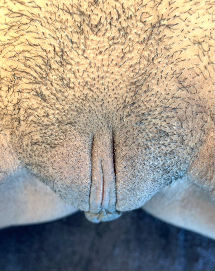 Atlanta labiaplasty near me best expert intimate plastic surgeon results before and after clitoral hood reduction vagina perineoplasty