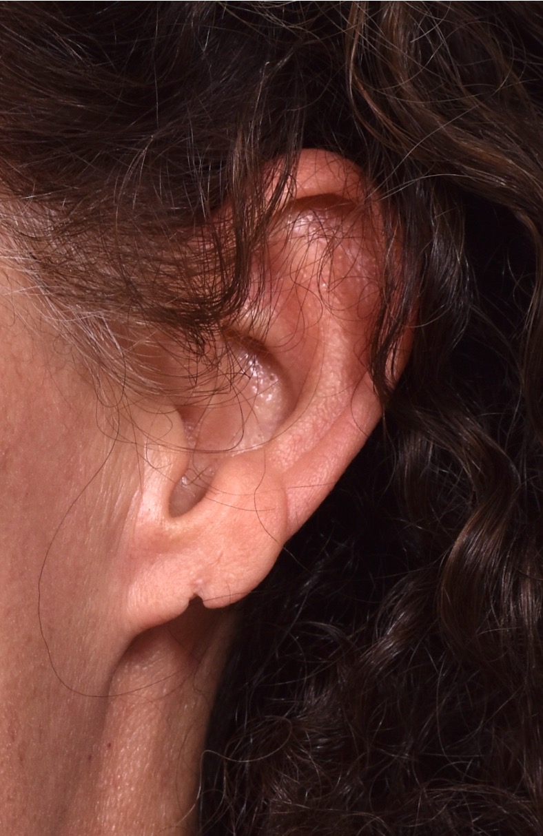 Earlobe repair near me Atlanta best before and after results earrings collagen