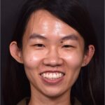 Mole shave treatment biopsy scarless surgery best near me collagen Atlanta