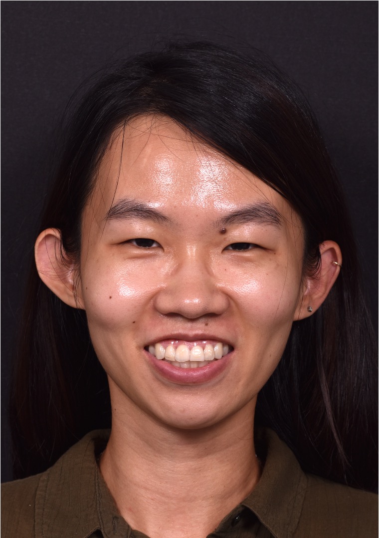 Mole shave treatment biopsy scarless surgery best near me collagen Atlanta