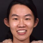 Mole shave treatment biopsy scarless surgery best near me collagen Atlanta