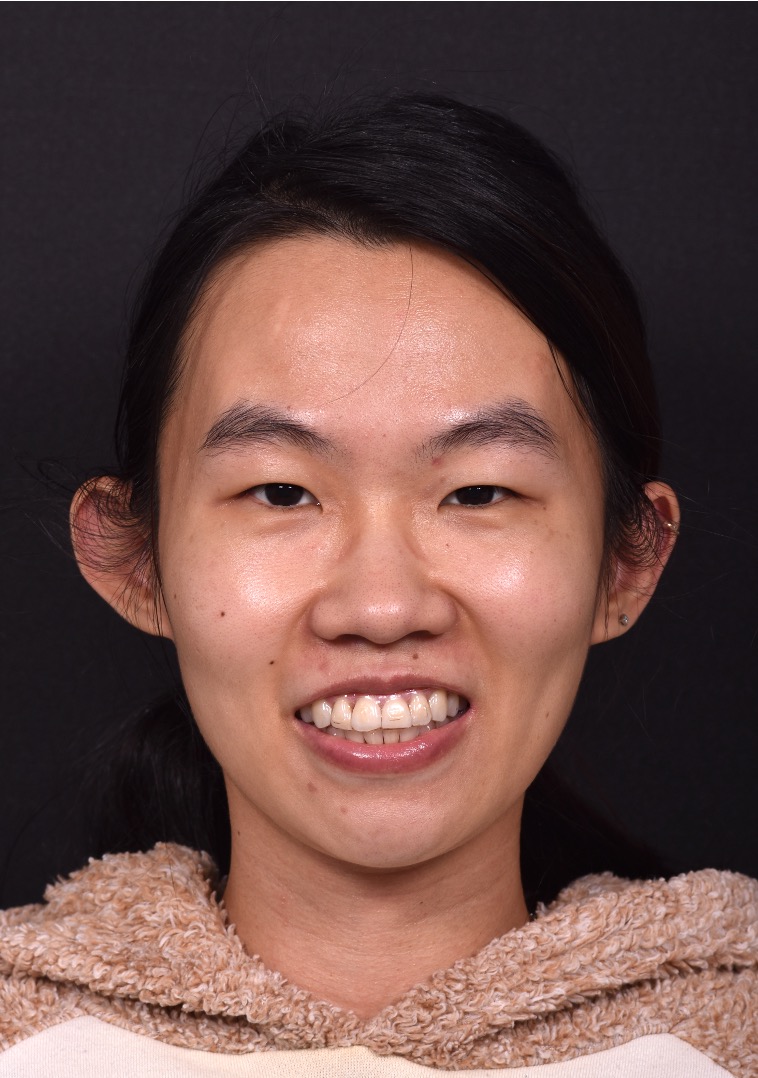 Mole shave treatment biopsy scarless surgery best near me collagen Atlanta