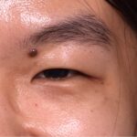 Mole shave treatment biopsy scarless surgery best near me collagen Atlanta