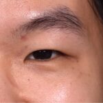 Mole shave treatment biopsy scarless surgery best near me collagen Atlanta