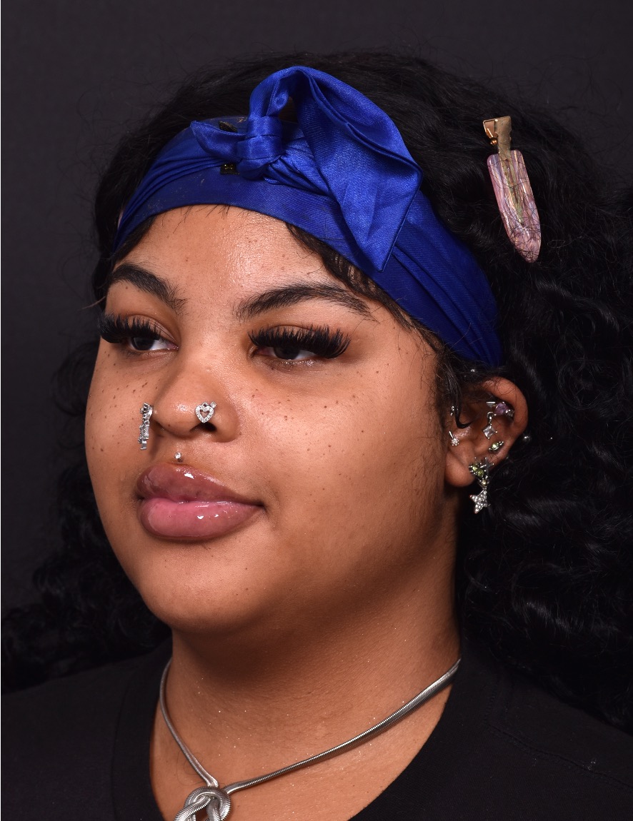 Deep plane neck lift isolated structural liposuction lipo before and after best expert near me collagen Atlanta