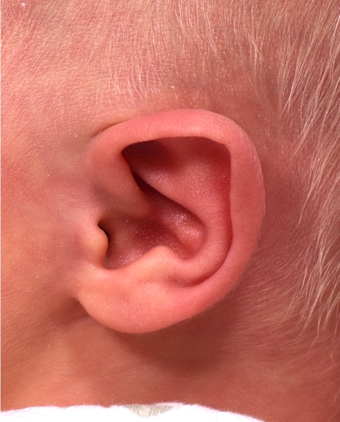 Atlanta Earwell baby ear correction nonsurgical near me best expert otoplasty