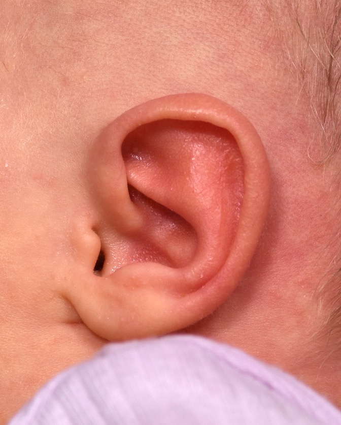 Atlanta Earwell baby ear correction nonsurgical near me best expert otoplasty