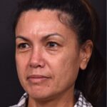 Atlanta blepharoplasty eyelid lift lid eyes eye surgery best expert female results before after