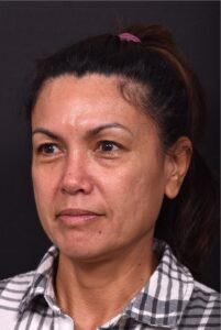 Atlanta blepharoplasty eyelid lift lid eyes eye surgery best expert female results before after