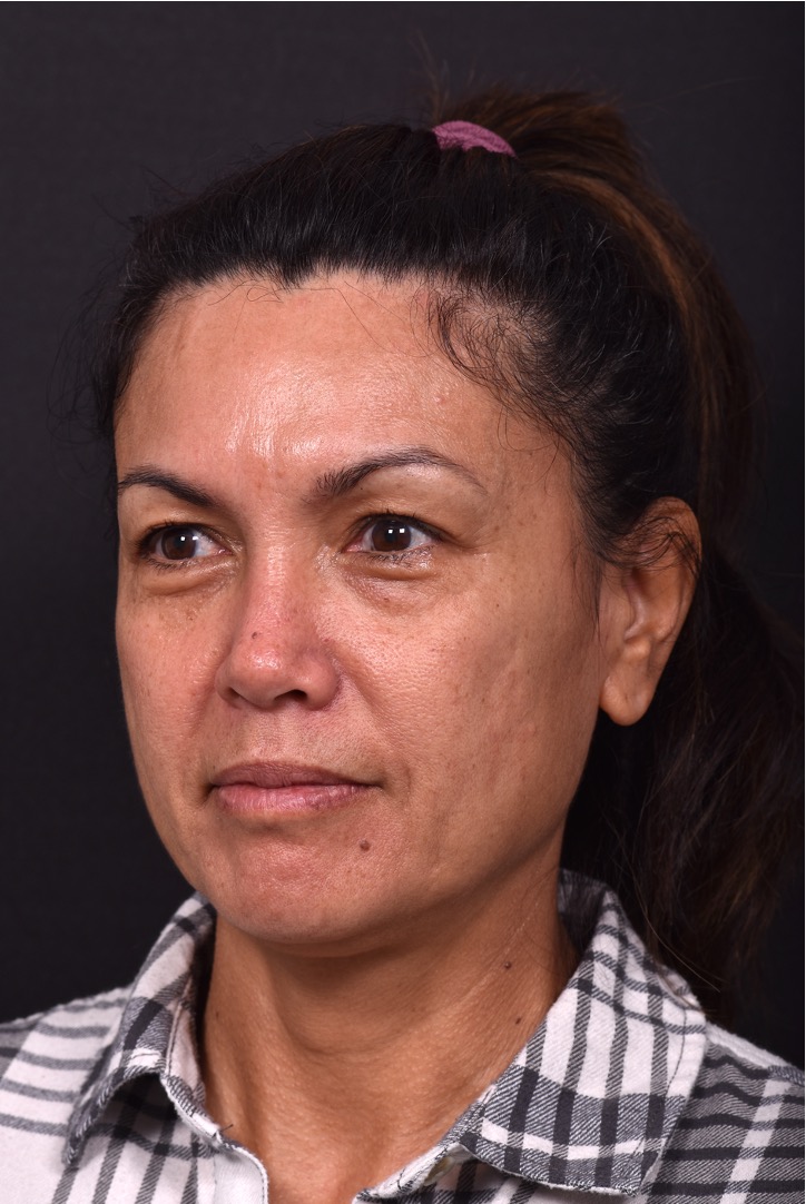 Atlanta blepharoplasty eyelid lift lid eyes eye surgery best expert female results before after