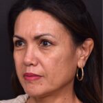 Atlanta blepharoplasty eyelid lift lid eyes eye surgery best expert female results before after