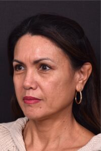 Atlanta blepharoplasty eyelid lift lid eyes eye surgery best expert female results before after