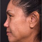 Atlanta blepharoplasty eyelid lift lid eyes eye surgery best expert female results before after