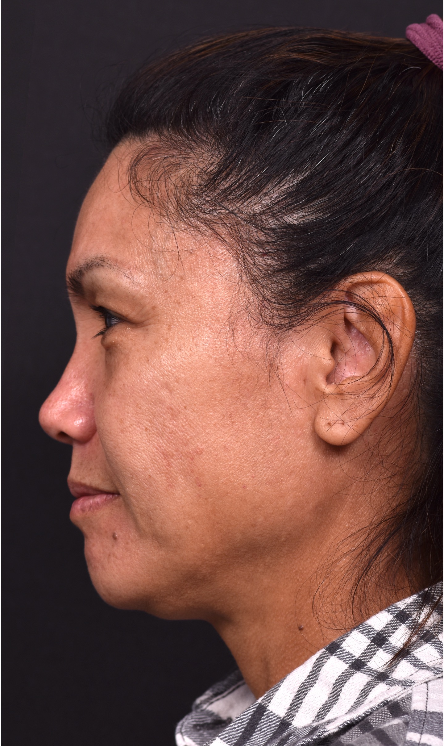 Atlanta blepharoplasty eyelid lift lid eyes eye surgery best expert female results before after