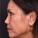 Atlanta blepharoplasty eyelid lift lid eyes eye surgery best expert female results before after