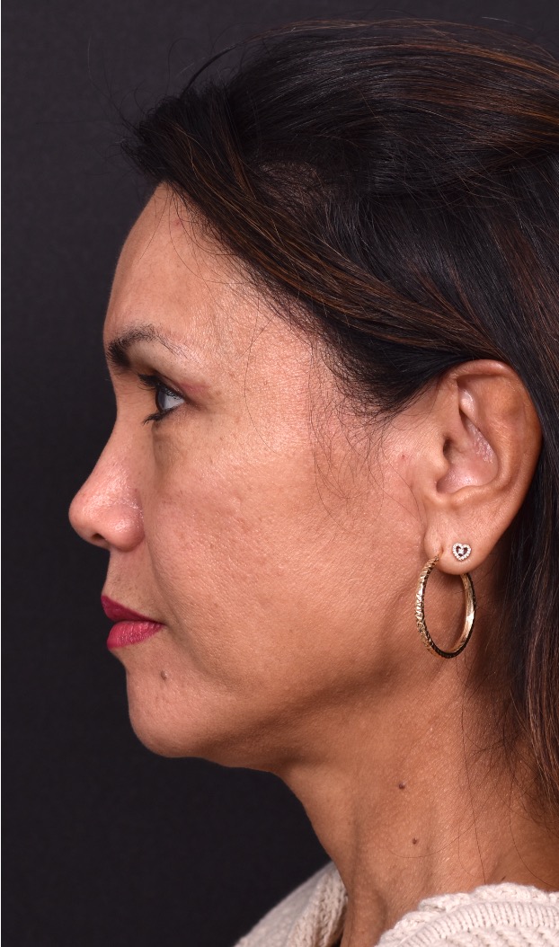 Atlanta blepharoplasty eyelid lift lid eyes eye surgery best expert female results before after