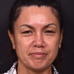 Atlanta blepharoplasty eyelid lift lid eyes eye surgery best expert female results before after