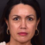 Atlanta blepharoplasty eyelid lift lid eyes eye surgery best expert female results before after