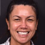 Atlanta blepharoplasty eyelid lift lid eyes eye surgery best expert female results before after