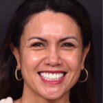 Atlanta blepharoplasty eyelid lift lid eyes eye surgery best expert female results before after