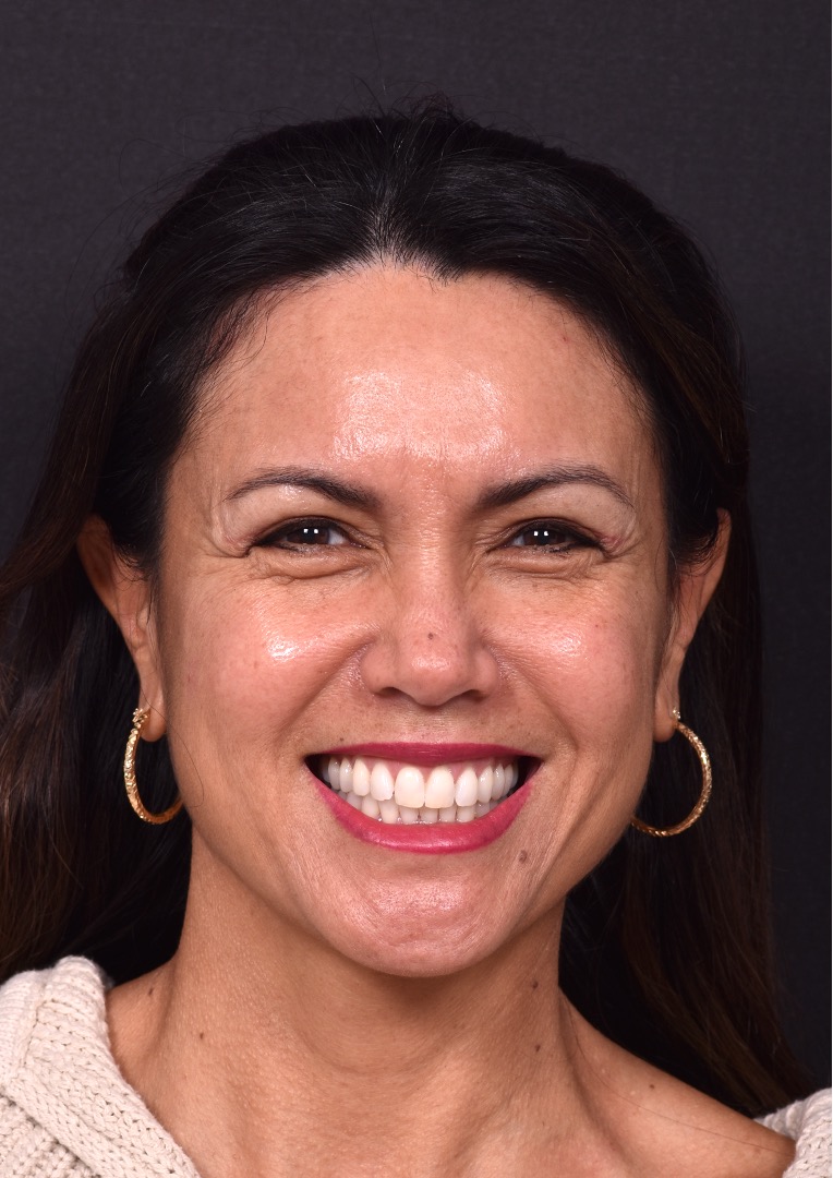 Atlanta blepharoplasty eyelid lift lid eyes eye surgery best expert female results before after