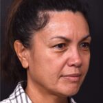 Atlanta blepharoplasty eyelid lift lid eyes eye surgery best expert female results before after