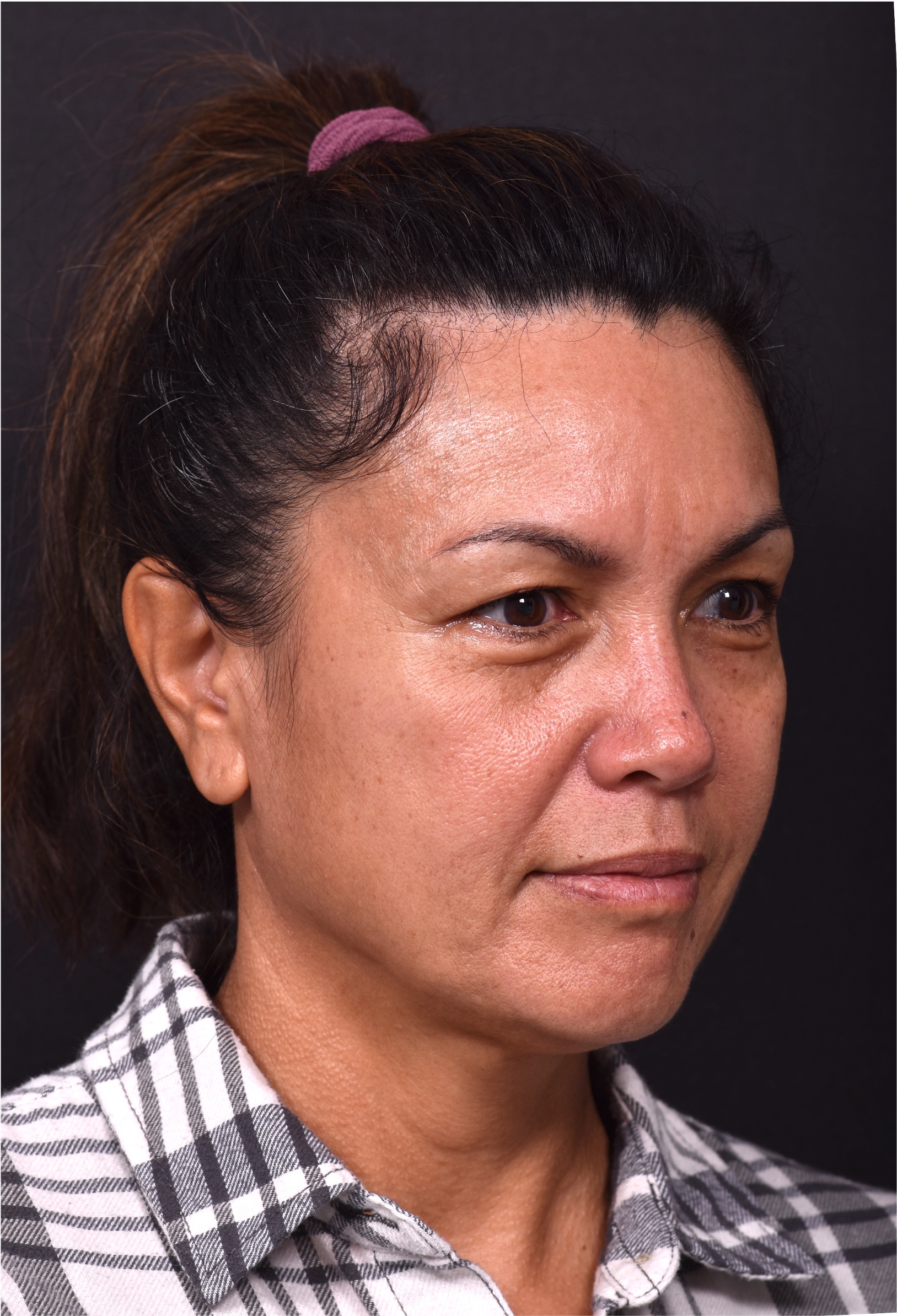 Atlanta blepharoplasty eyelid lift lid eyes eye surgery best expert female results before after