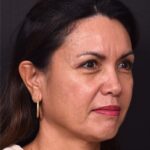 Atlanta blepharoplasty eyelid lift lid eyes eye surgery best expert female results before after