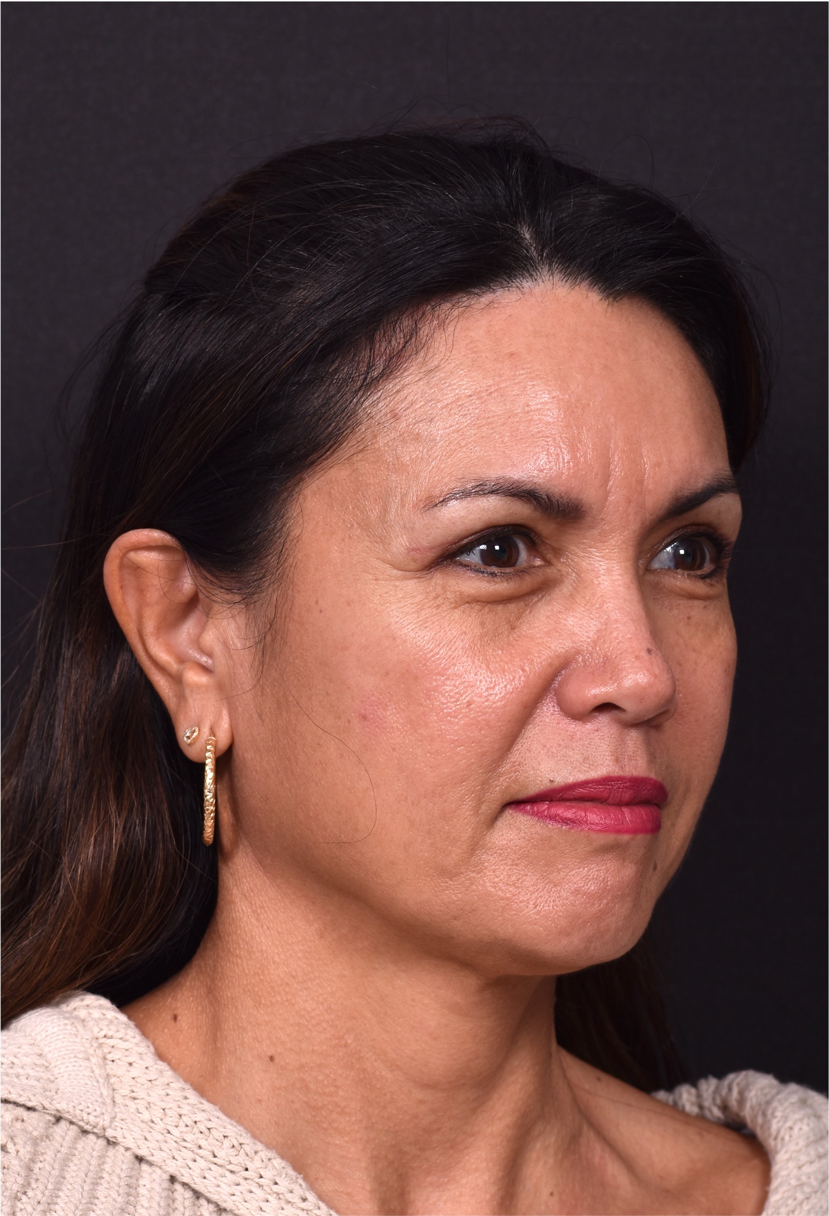 Atlanta blepharoplasty eyelid lift lid eyes eye surgery best expert female results before after