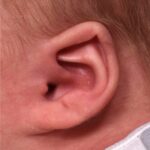 Earwells Earwell Atlanta before after ear baby otoplasty congenital correction best near me expert