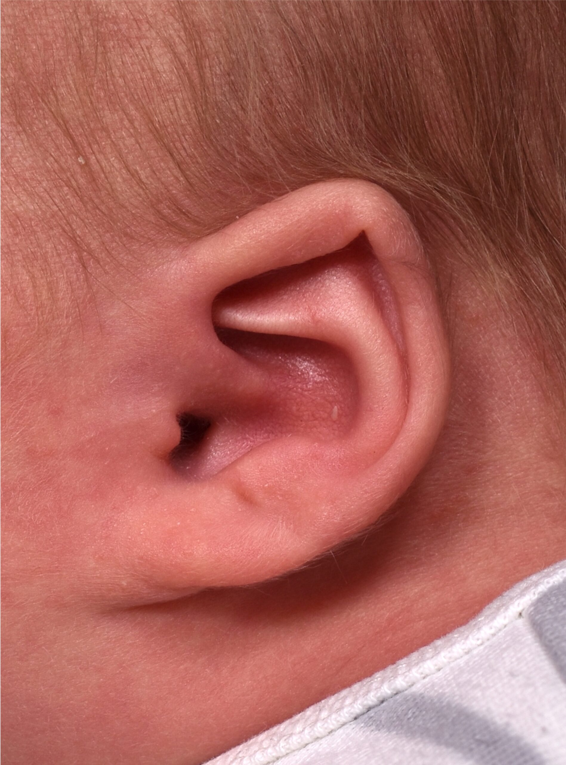 Earwells Earwell Atlanta before after ear baby otoplasty congenital correction best near me expert
