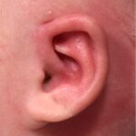Earwells Earwell Atlanta before after ear baby otoplasty congenital correction best near me expert
