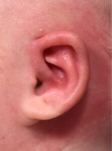 Earwells Earwell Atlanta before after ear baby otoplasty congenital correction best near me expert