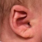 Earwells Earwell Atlanta before after ear baby otoplasty congenital correction best near me expert