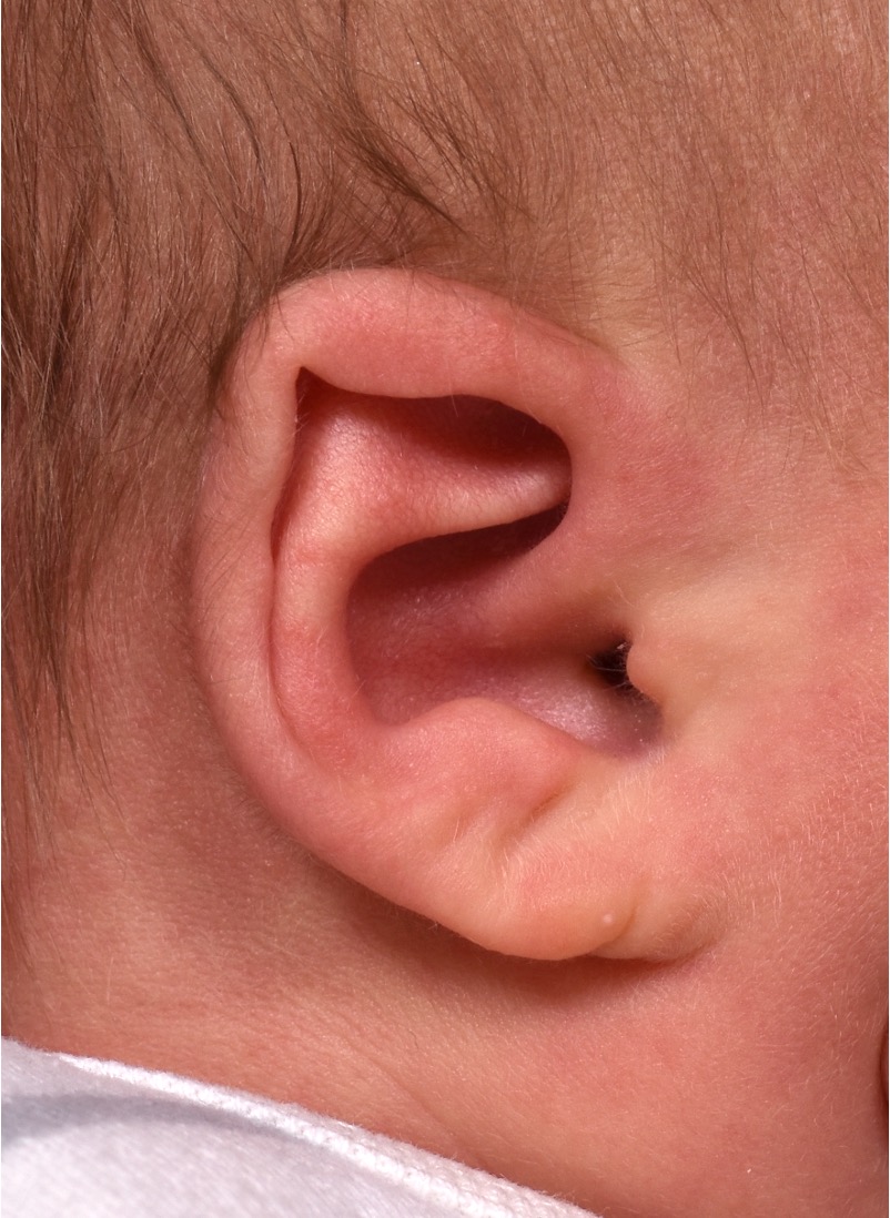 Earwells Earwell Atlanta before after ear baby otoplasty congenital correction best near me expert