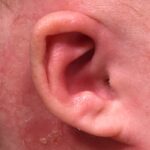 Earwells Earwell Atlanta before after ear baby otoplasty congenital correction best near me expert