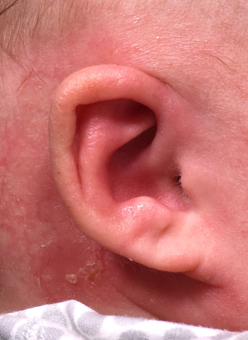 Earwells Earwell Atlanta before after ear baby otoplasty congenital correction best near me expert