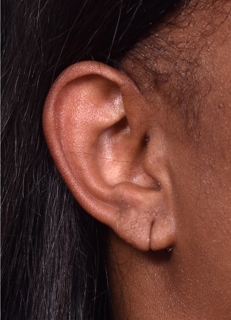 Torn earlobe repair near me Atlanta best before and after results earrings collagen expert