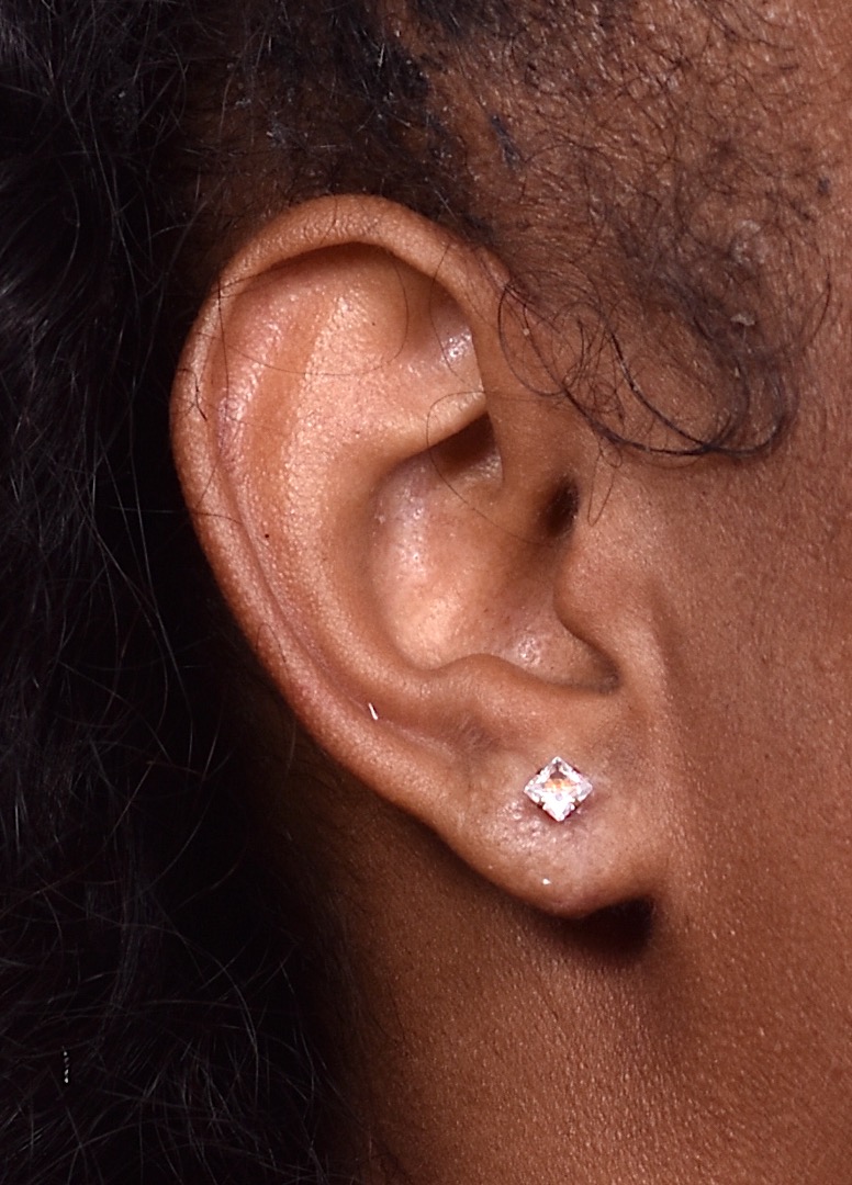 Torn earlobe repair near me Atlanta best before and after results earrings collagen expert