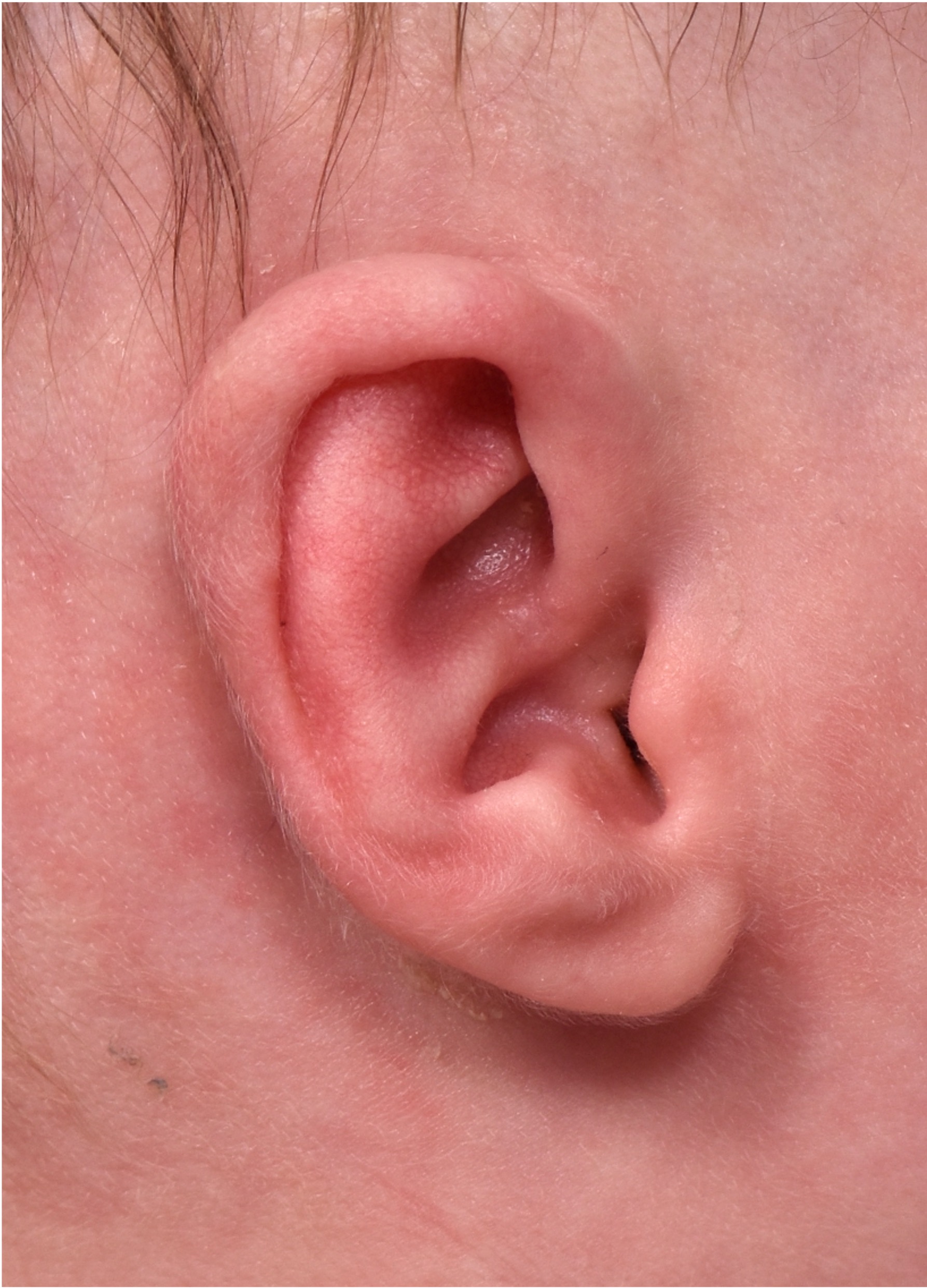 Earwells Earwell Atlanta before after ear baby otoplasty congenital correction best near me expert treatment