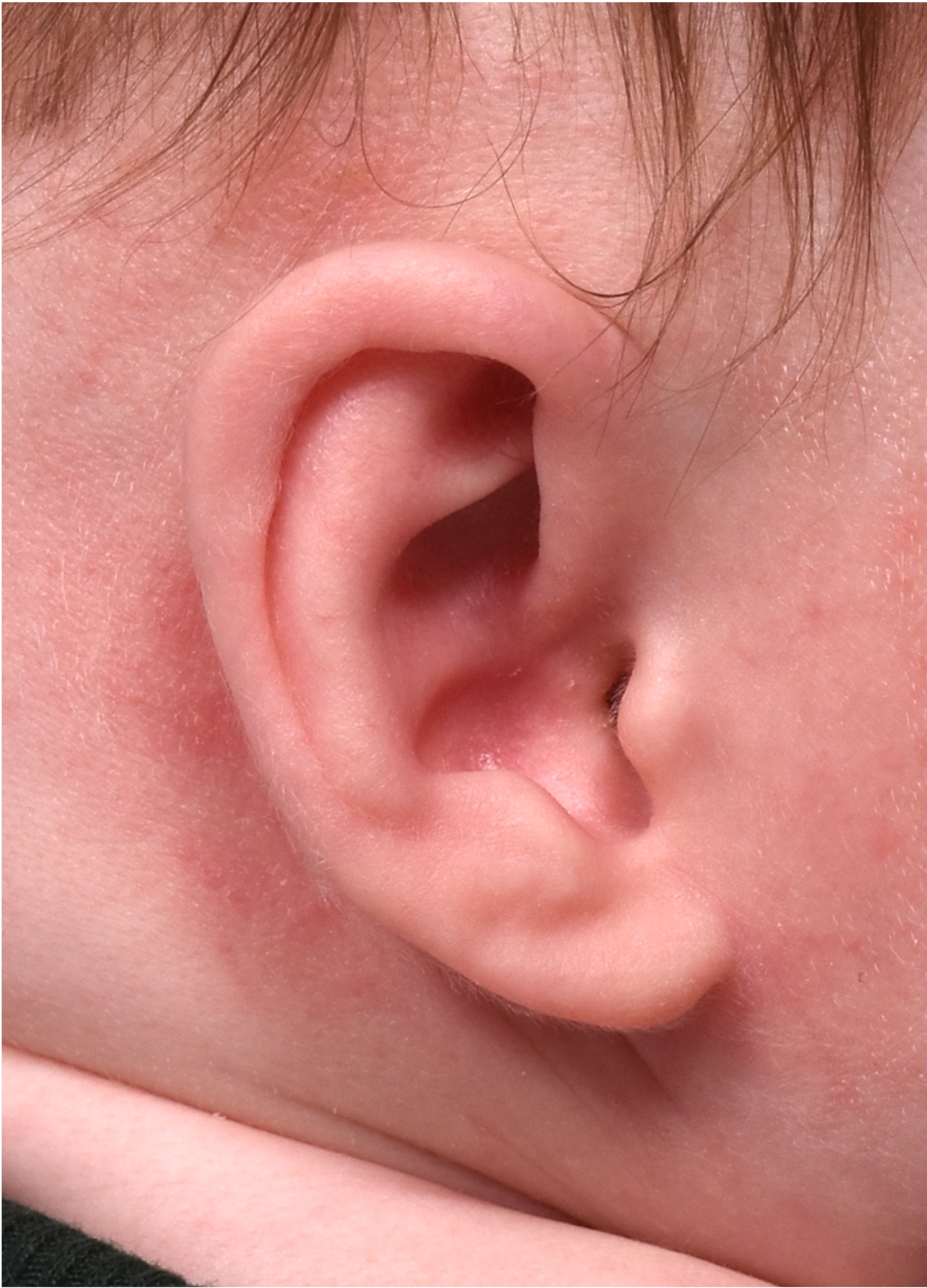 Earwells Earwell Atlanta before after ear baby otoplasty congenital correction best near me expert treatment