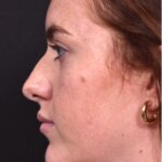Atlanta preservation rhinoplasty ultrasonic before after expert top Atlanta nose job best