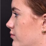 Atlanta preservation rhinoplasty ultrasonic before after expert top Atlanta nose job best