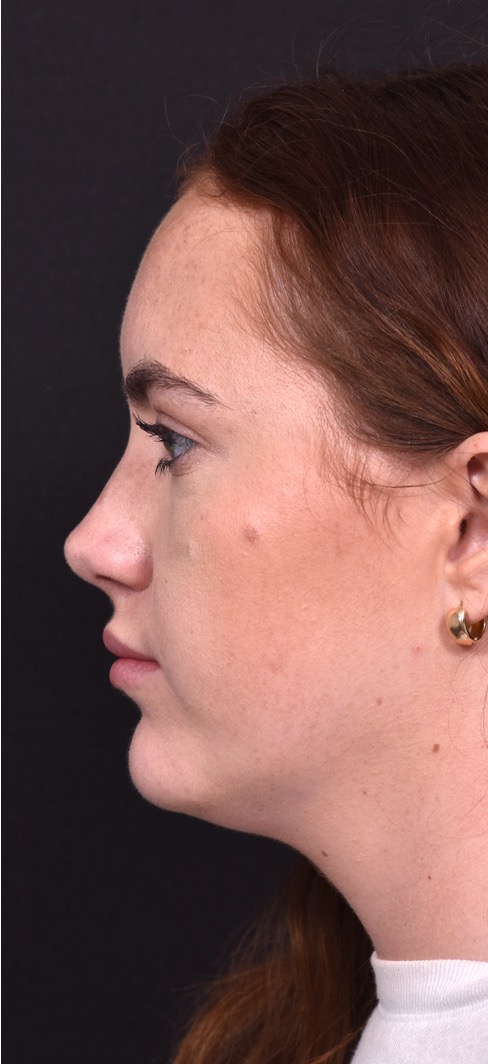 Atlanta preservation rhinoplasty ultrasonic before after expert top Atlanta nose job best