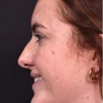 Atlanta preservation rhinoplasty ultrasonic before after expert top Atlanta nose job best