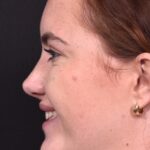 Atlanta preservation rhinoplasty ultrasonic before after expert top Atlanta nose job best